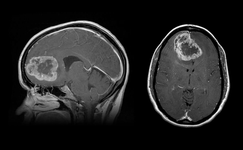 Tumeurs cérébrales Neurochirurgie SCP Neurochirurgiens